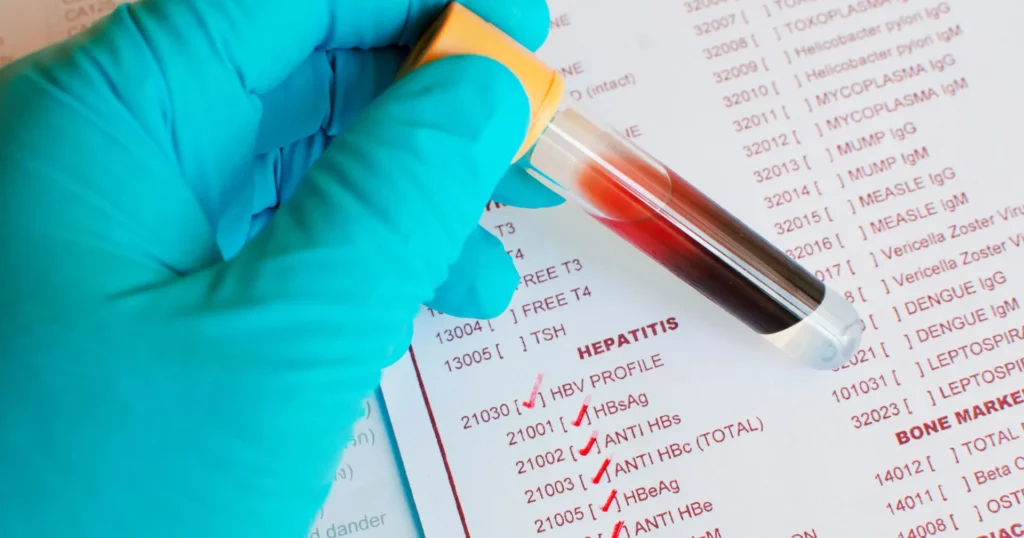 Hepatitis B važnost laboratorijske dijagnostike 1 Hepatitis B