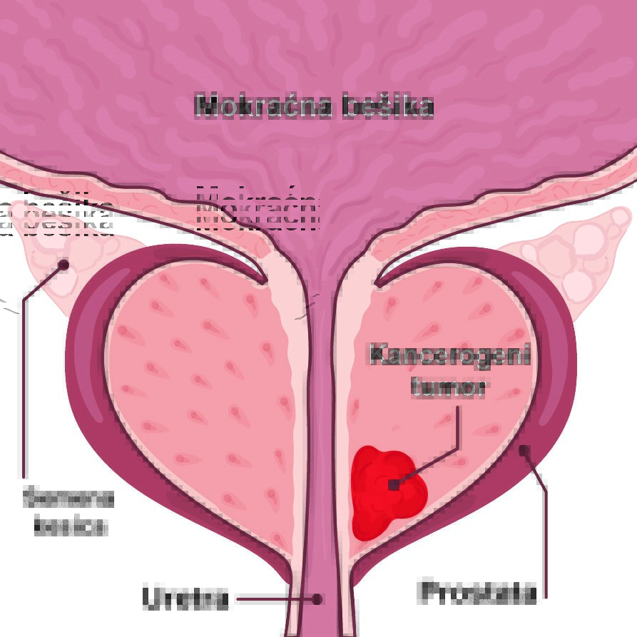Oboljenja prostate-simptomi, dijagnoza i laboratorijski testovi 6 Oboljenja prostate-simptomi, dijagnoza i laboratorijski testovi 3