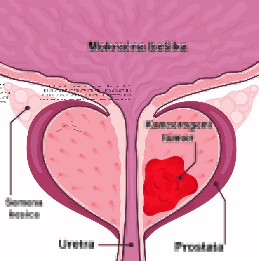 Oboljenja prostate-simptomi, dijagnoza i laboratorijski testovi 7 Oboljenja prostate-simptomi, dijagnoza i laboratorijski testovi 4