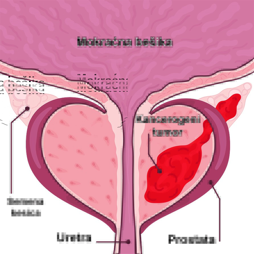Oboljenja prostate-simptomi, dijagnoza i laboratorijski testovi 8 Oboljenja prostate-simptomi, dijagnoza i laboratorijski testovi 5