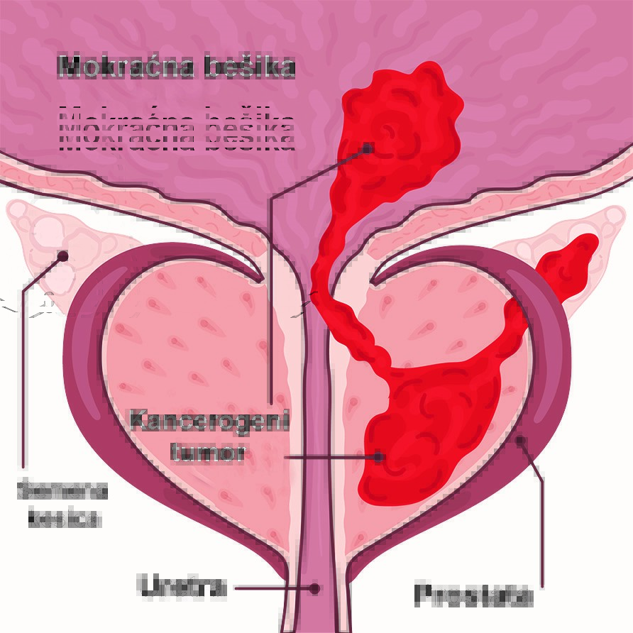 Oboljenja prostate-simptomi, dijagnoza i laboratorijski testovi 9 Oboljenja prostate-simptomi, dijagnoza i laboratorijski testovi 6