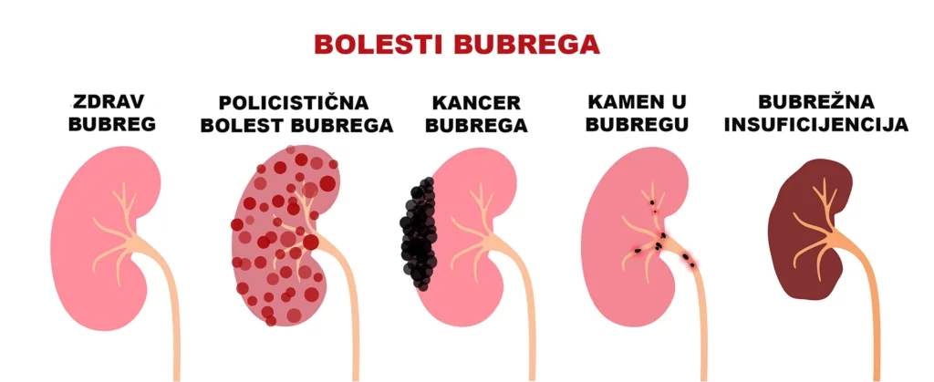 Bolesti bubrega – simptomi, uzroci, dijagnostika i terapija 4 Bolesti bubrega – simptomi, uzroci, dijagnostika i terapija 3