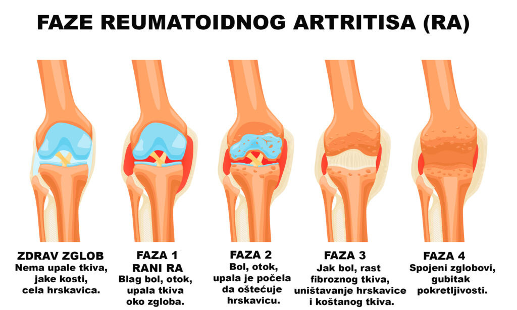 Reumatoidni artritis – simptomi, uzroci, dijagnostika i terapija 9 Reumatoidni artritis – simptomi, uzroci, dijagnostika i terapija 4