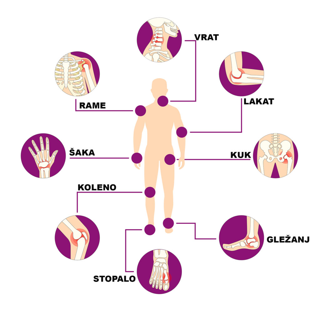 Reumatoidni artritis – simptomi, uzroci, dijagnostika i terapija 1 Reumatoidni artritis – simptomi, uzroci, dijagnostika i terapija 1
