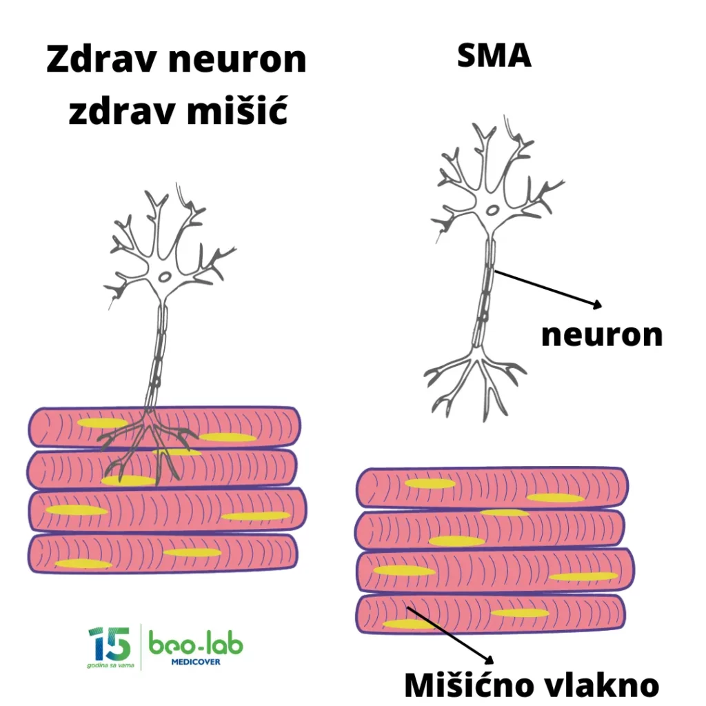 Spinalna mišićna atrofija-simptomi, uzrok nastanka, postavljanje dijagnoze i lečenje 3 Spinalna mišićna atrofija-simptomi, uzrok nastanka, postavljanje dijagnoze i lečenje 3