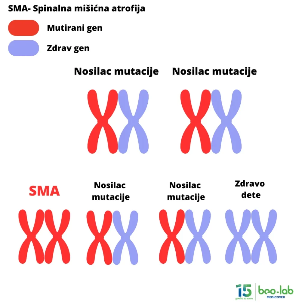 Spinalna mišićna atrofija-simptomi, uzrok nastanka, postavljanje dijagnoze i lečenje 4 Spinalna mišićna atrofija-simptomi, uzrok nastanka, postavljanje dijagnoze i lečenje 4