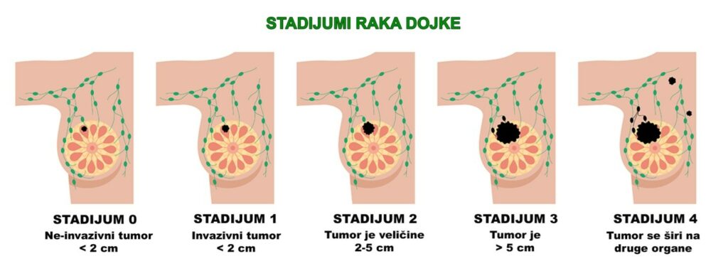 Rak dojke – šta bi svaka žena trebalo da zna? 3 Stadijumi raka dojke