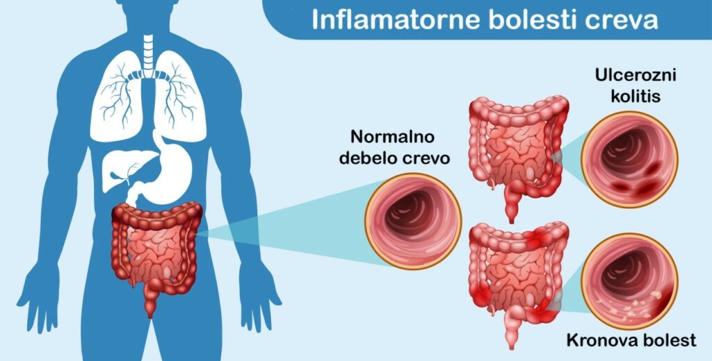 Inflamatorne bolesti creva - simptomi, dijagnoza, terapija i laboratorijska dijagnostika 1 Tipovi inflamatornih bolesti creva