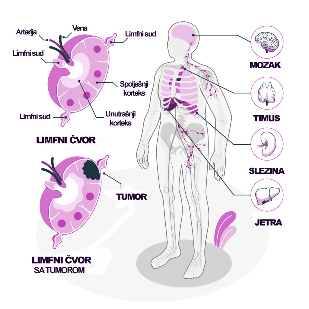 Uloga patohistološke laboratorije u postavljanju dijagnoze i lečenju limfoma 19